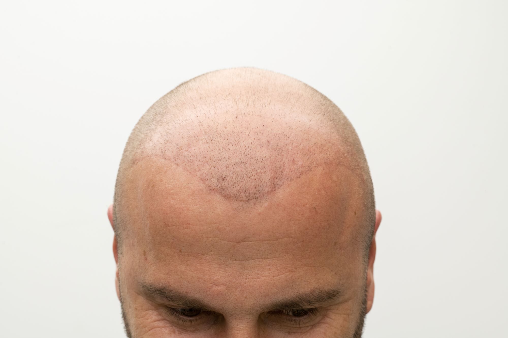 Medico de Seguro de Salud Implante Capilar con Adeslas | Otros tratamientos dermatológicos